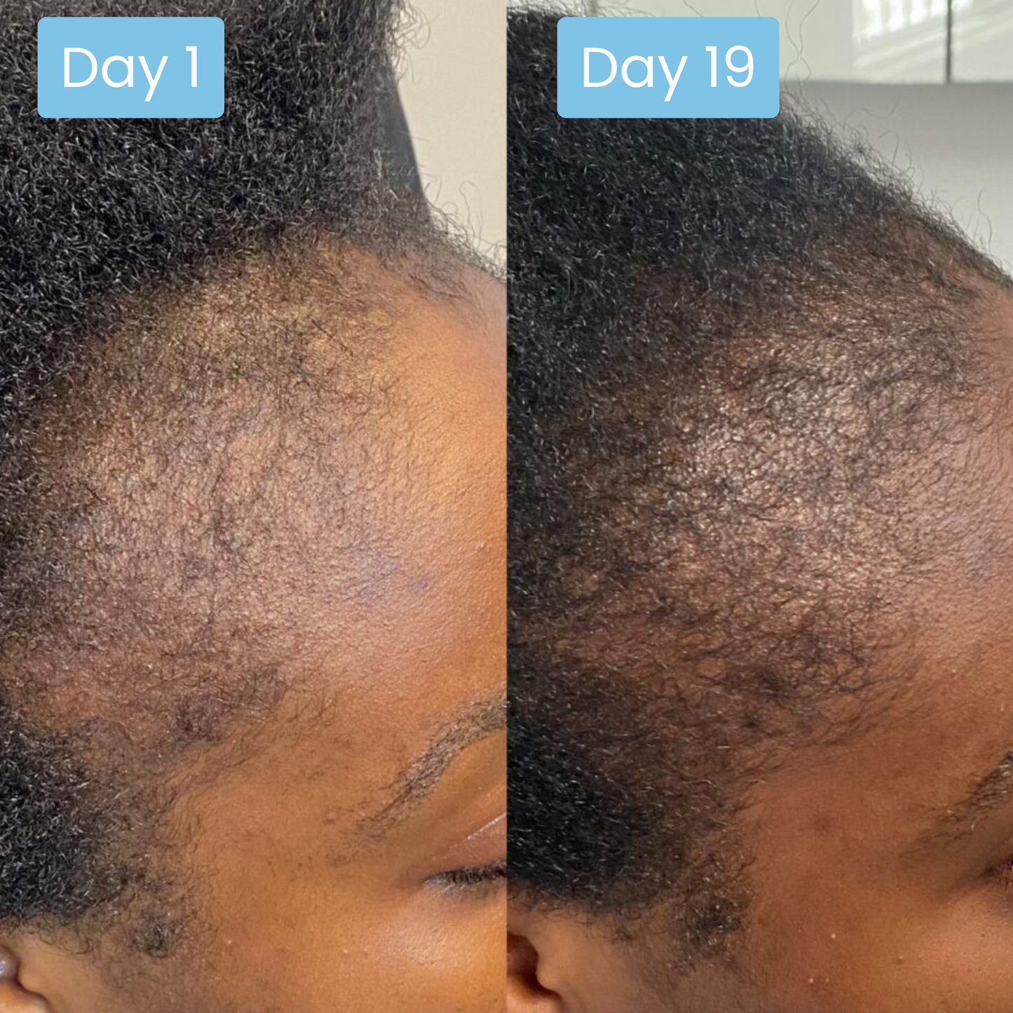 Scalpy® Hair Growth Ampoule